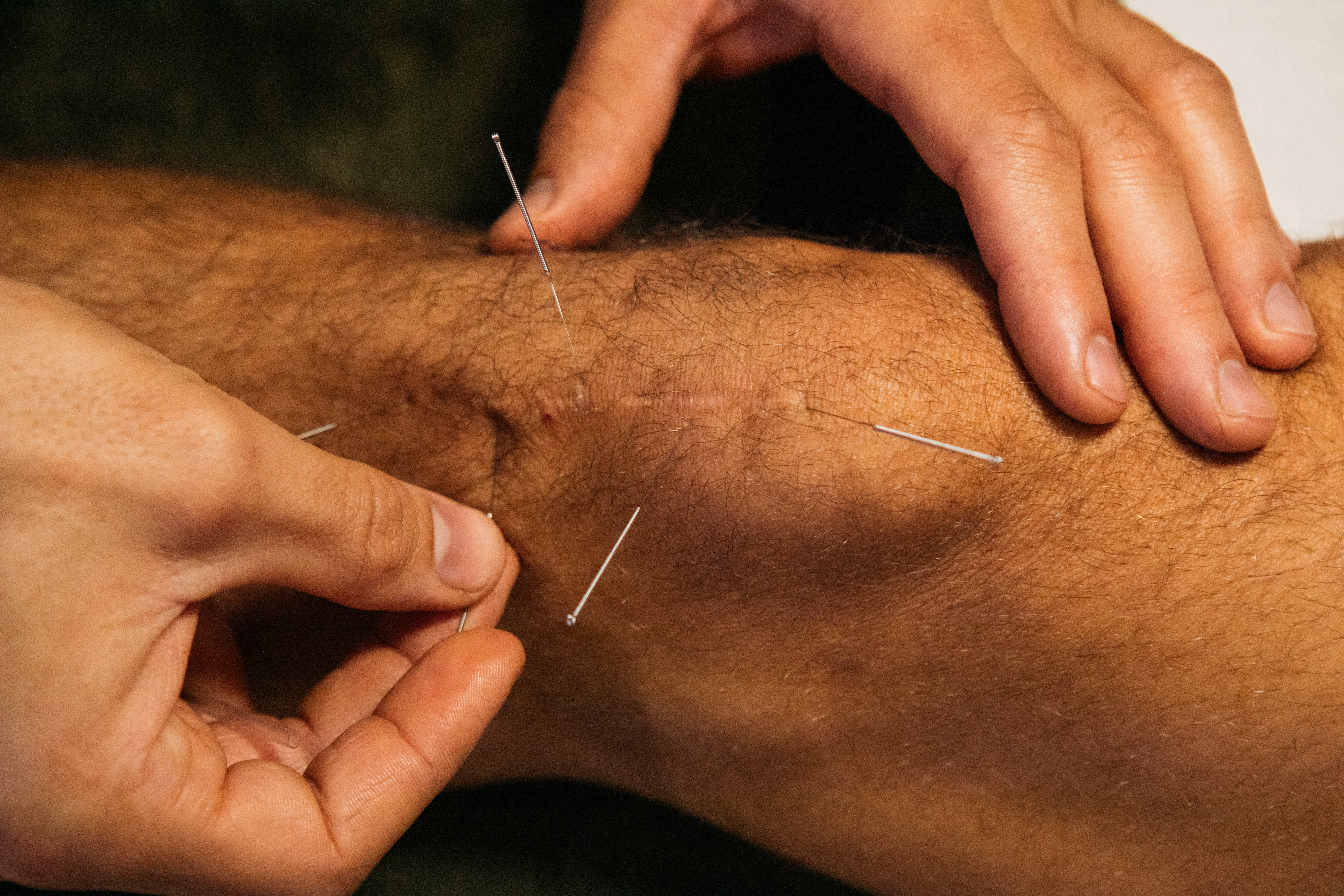 Close-up of a person's knee with two hands, one pressing and the other holding the skin, showing a medical procedure.