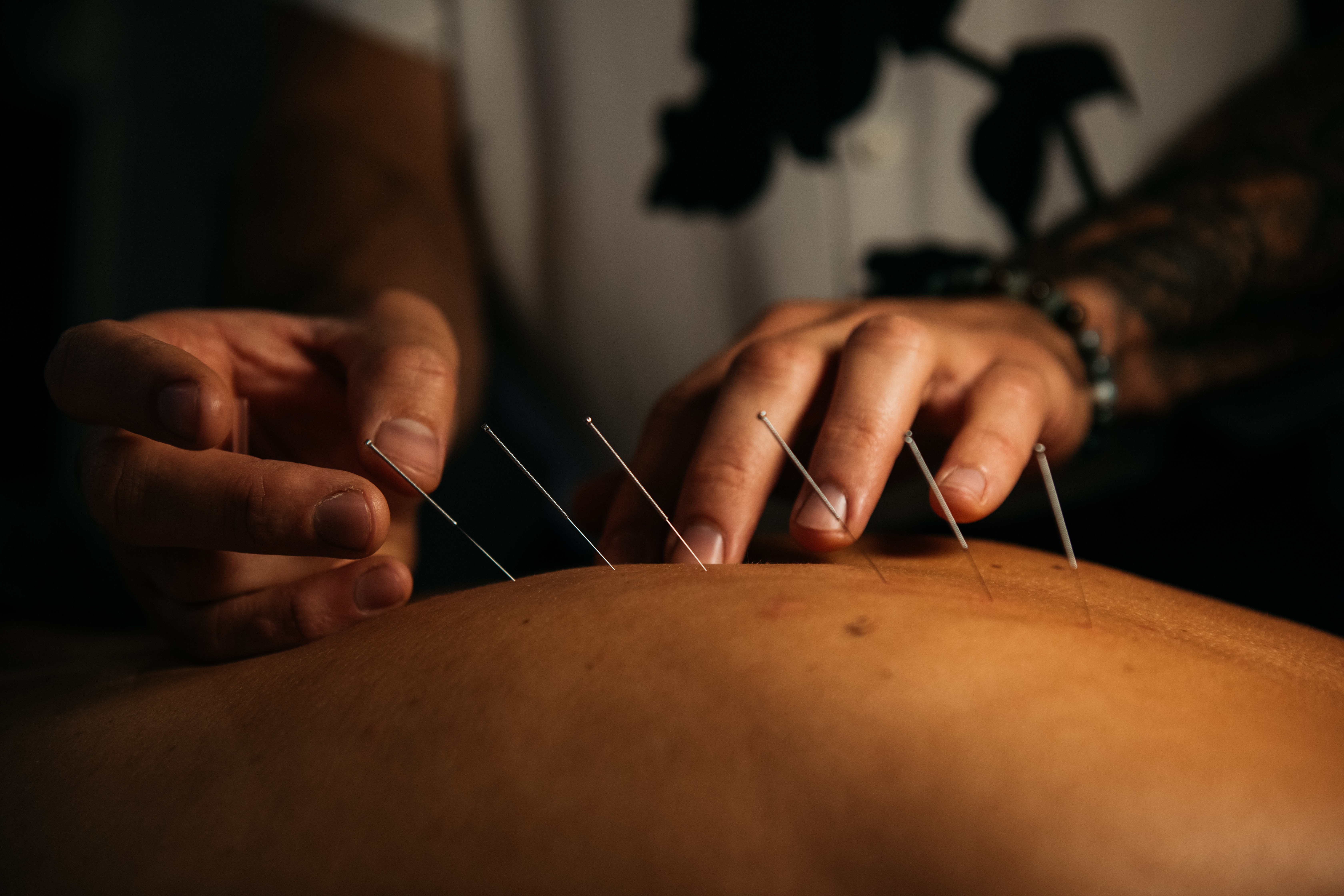 Person performing acupuncture on a person's back with thin needles, close-up view, dim lighting.