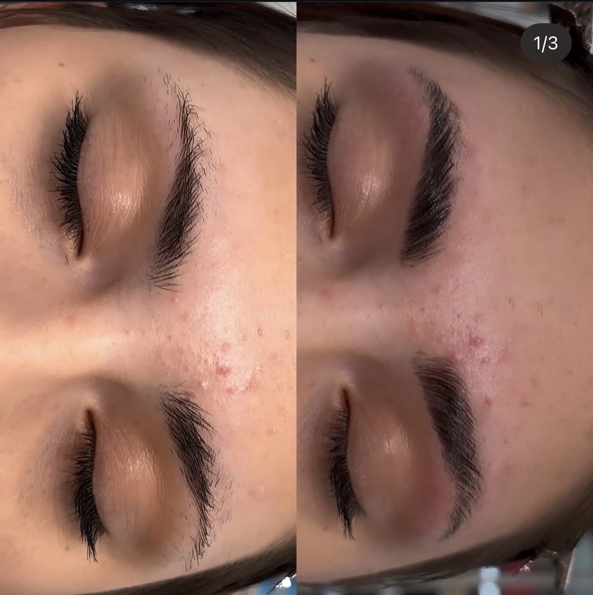 Close-up of a person's face with before and after images showing skin improvement, eyes closed, eyebrows visible.