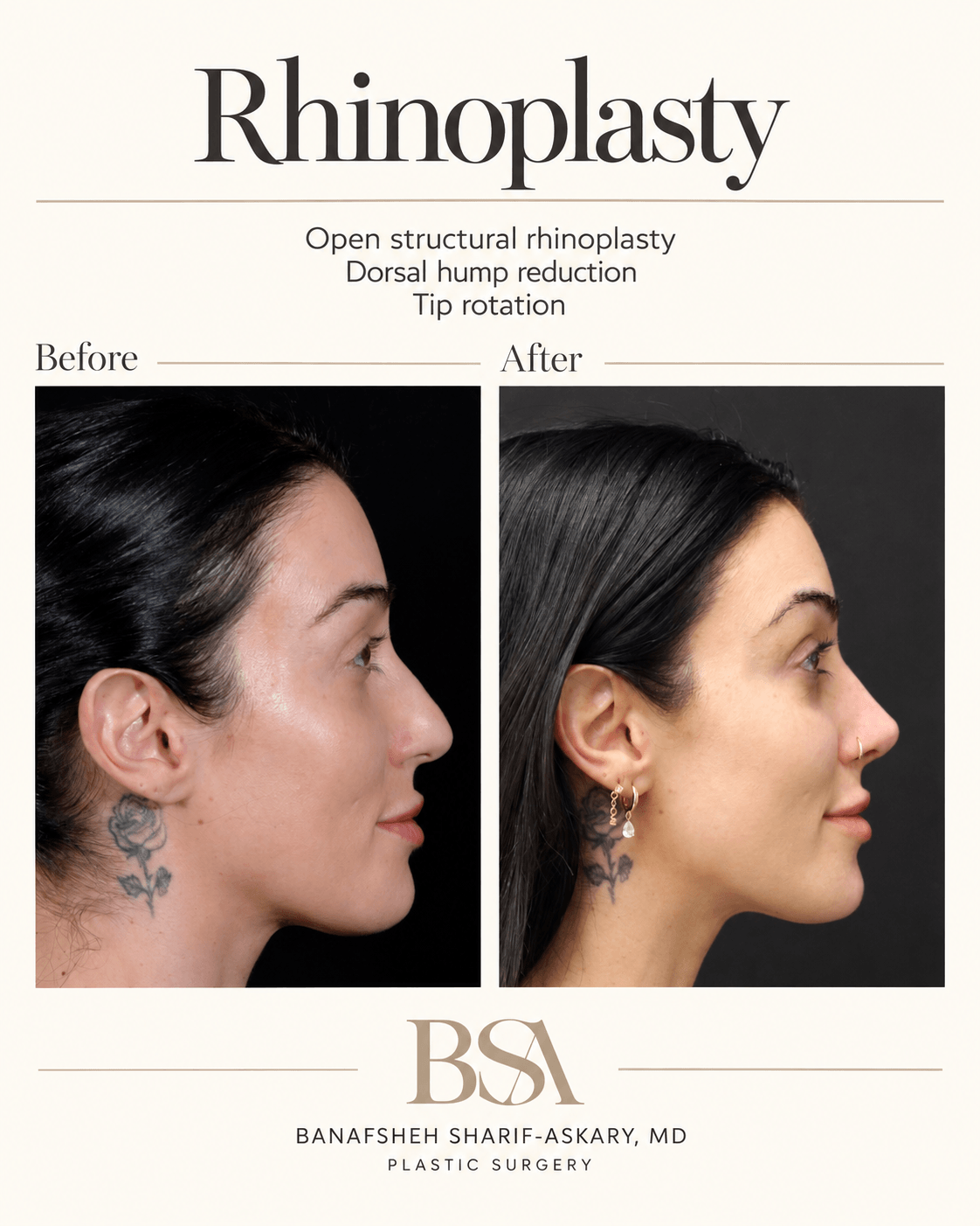 Comparison of a woman's profile before and after rhinoplasty, showing improved nasal shape and facial harmony.