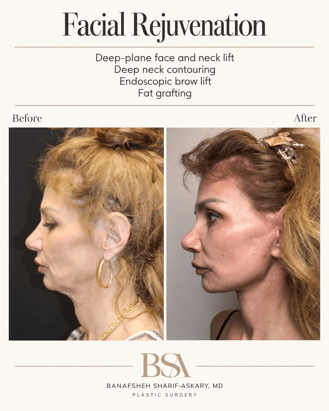 Side-by-side before and after photos of a woman showing facial rejuvenation results, with text about facial procedures above.